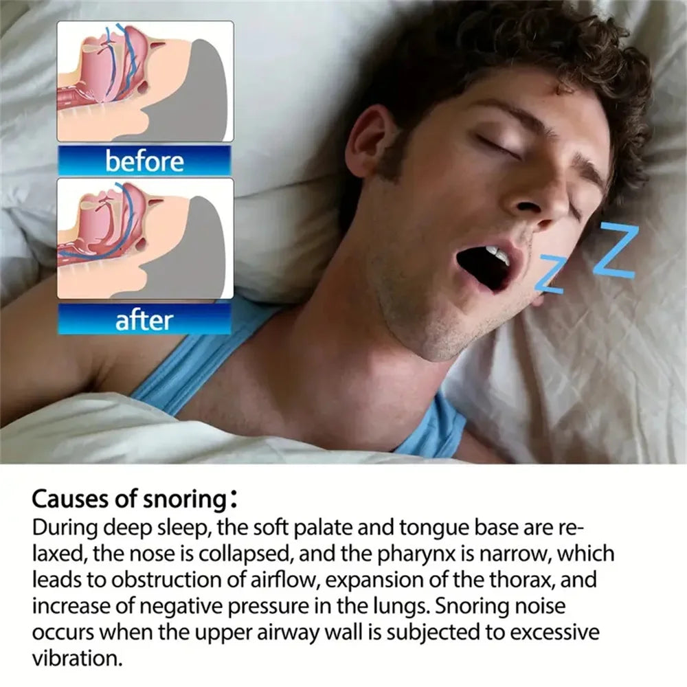 20-100pcs Snoring Stickers Breathing Nose Strips Physical Airway Expansion for Improved Nose Vent Anti-Snoring Comfort Sleep Aid